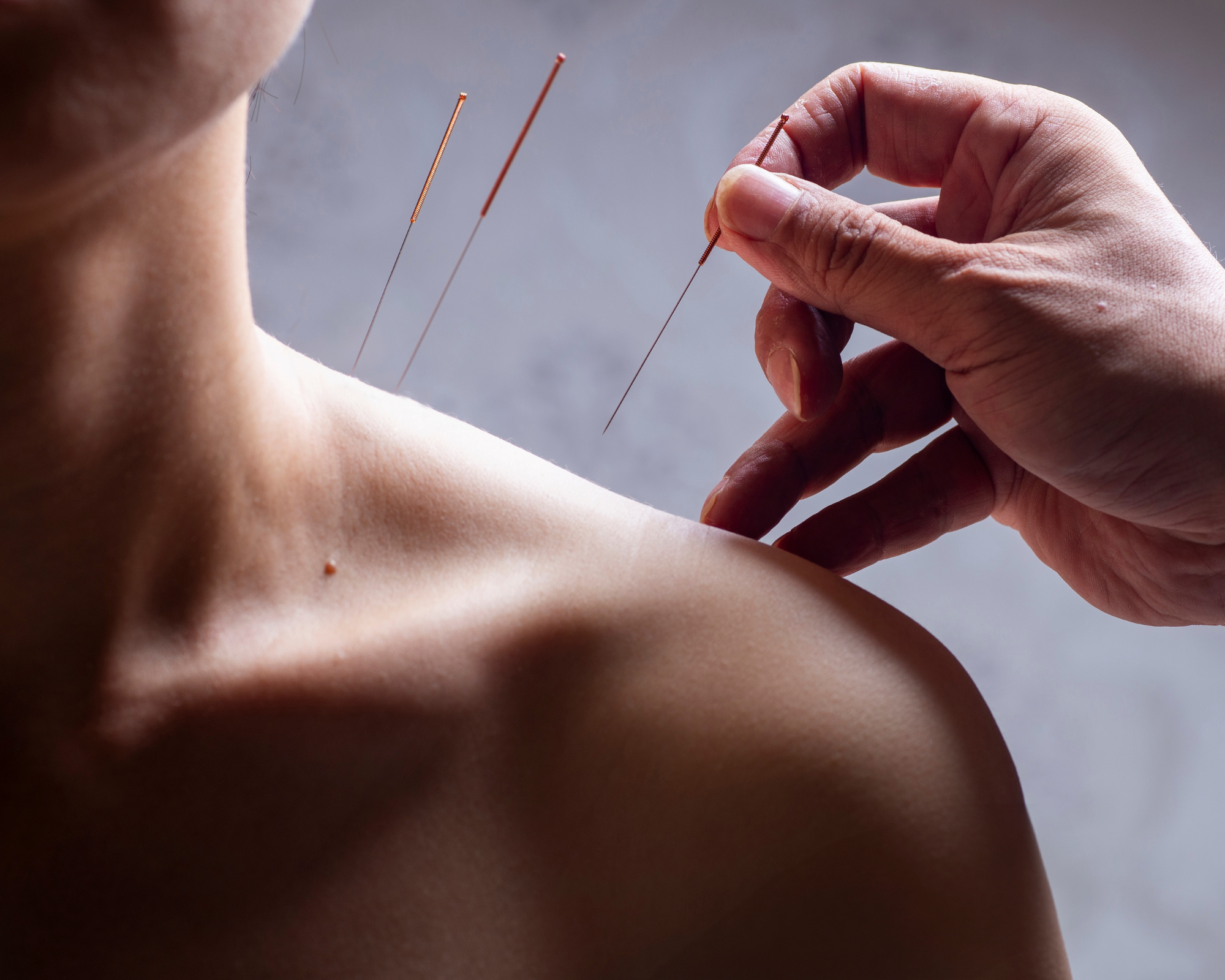 Holistic Healing: The Power of Acupuncture and How It Supports Cancer Recovery